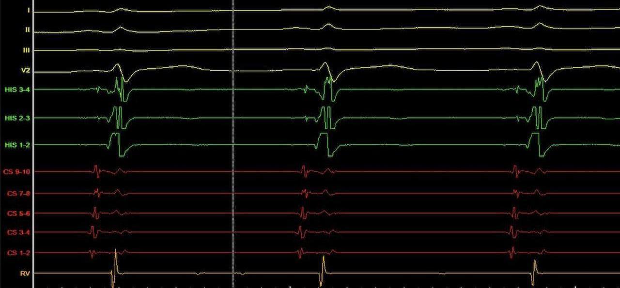 Ενδοκαρδιακά ηλεκτρογράμματα